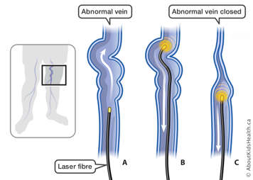 Laser fibre inserted into abnormal vein in the leg and then turned on as it&rsquo;s pulled back out to close the vein