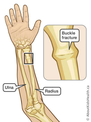 Illustration of arm with buckle fracture in the radius