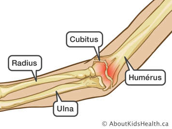 Un bras avec fracture de l‘humérus