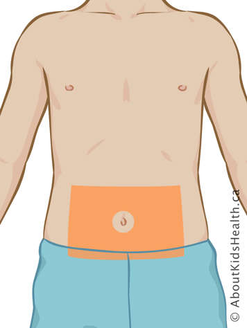 Marking on lower abdomen indicating insulin injection site