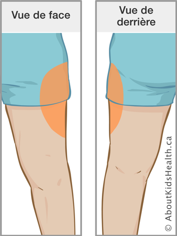 Vue de face et vue de derrière de la site d’injection d’insuline sur la cuisse