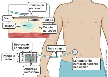 Une pompe à insuline avec boutons de commande, affichage numérique, tube souple et trousse de perfusion contenant une canule