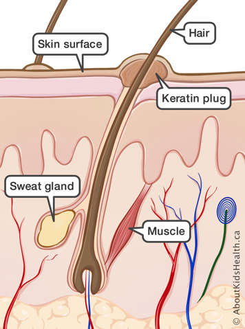 Cross section of skin affected by keratosis pilaris