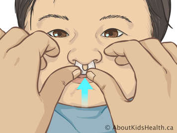 Inserting stent into baby’s nose