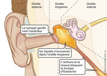 Un tympan gonflé à cause de l’enflure et des blocages dans la trompe d’Eustache