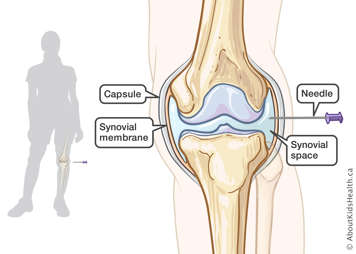 Needle inserted into synovial space of knee joint