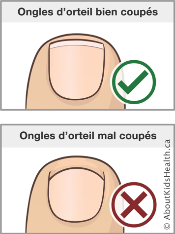 Illustration d’un ongle d’orteil bien coupé et d’un ongle d’orteil mal coupé