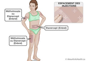 L’emplacement des sites d’injections de la methotrexate et de l’étanercept sur le corps d’une fille