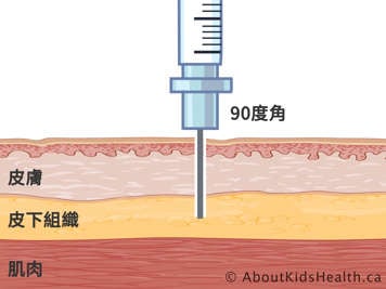 以九十度角注射針頭的皮膚、皮下組織和肌肉的橫切面