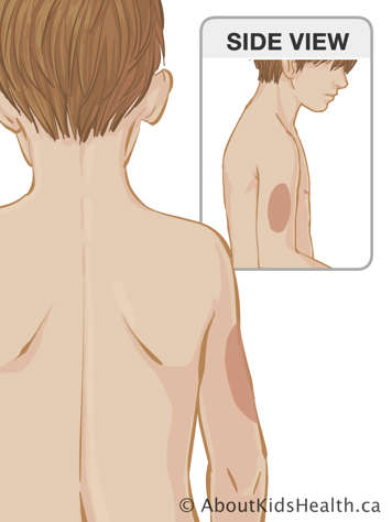 Upper body of child with marking on upper arm for injection