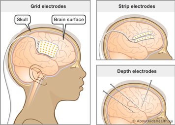 Illustrations of brain with grid electrodes, strip electrodes, and depth electrodes