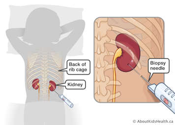 A view of the back of the rib cage and kidneys of a girl on her back with a biopsy needle inserted into her left kidney