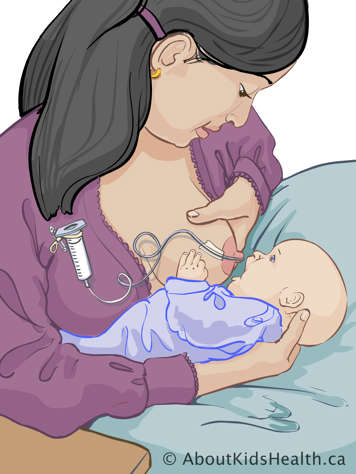 Mother feeding baby with lactation aid using a syringe