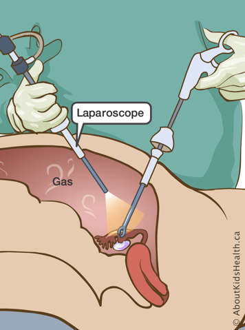 Laparoscope and gas inside abdomen