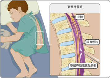 近距離示意圖：位於頭骨和大腦之間的正常腦膜，以及發炎的腦膜