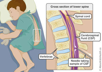 Cross section of lower spine with needle inserted between vertebrae taking a sample of cerebrospinal fluid