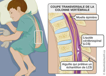 L’identification de la moelle épinière, du liquide cérébrospinal (LCS) et d’une aiguille qui prélève un échantillon de LCS