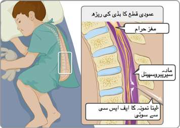 ریڑھ کی ہڈی، حرام مغز اور دماغی نخاعی مائع (سی ایس ایف) جن میں سی ایس ایف کا نمونہ لینے کیلئے سوئی داخل کی گئی ہے