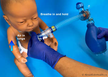 As the child breathes in, the LVR bag is squeezed