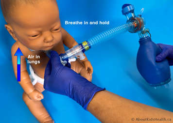 As the child breathes in, the LVR bag is squeezed and breath stacking occurs