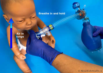 As the child breathes in, the LVR bag is squeezed and breath stacking occurs