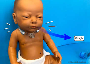 Encourage the child to actively cough out