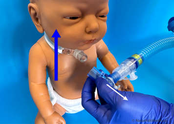 The child should hold in the air as long as possible and the LVR should be removed before the child coughs out