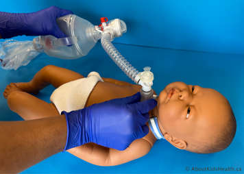 A manual resuscitation bag being used with a stoma mask on a baby