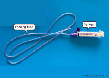 Feeding tube with syringe attached