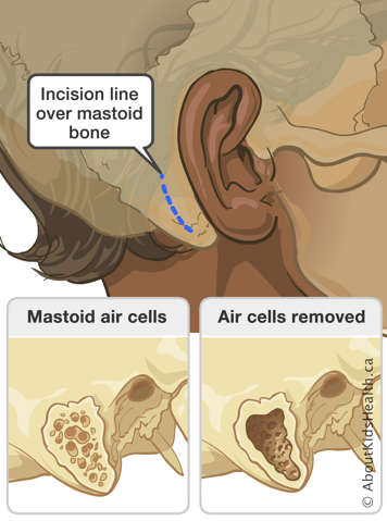 Incision line over mastoid bone on side of head and close-up of bone with mastoid air cells and with air cells removed