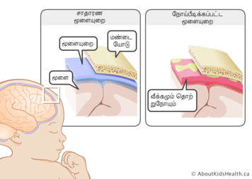 மூளைக்கும் மண்டை ஓட்டுக்கும் இடையில் உள்ள மென்சவ்வையும் தொற்றுதலுக்கு உட்பட்ட வீக்கமடைந்த மென்சவ்வையும் கிட்டவாகக் காட்டும் படம்