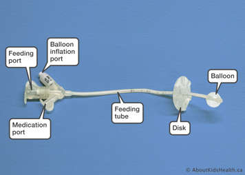 Parts of a Mic-G tube