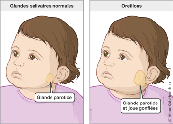 Un tout-petit avec la glande parotide ou salivaire normale et un tout-petit avec la glande parotide et la joue gonflée