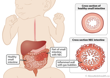 Cross section of healthy small intestine compared to cross section of NEC intestine showing inflamed wall with gas bubbles