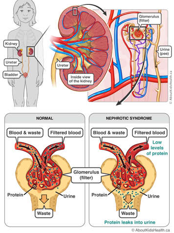 The glomeruli in nephrotic syndrome allow protein to leak into the urine.