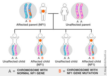 Chromosome distribution from an affected parent with one chromosome with NF1 gene mutation an unaffected parent