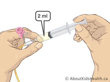 Dos mililitros de líquido en una jeringa conectada con una sonda nasogástrica