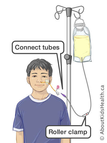 Connect tubes and roller clamp on infusion tubing for attaching a feeding bag to a child’s NG tube