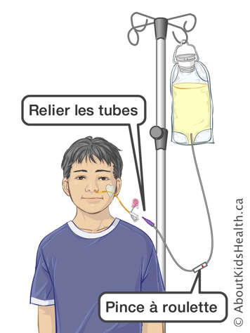 Adaptateur et pince à roulette sur une tubulure de perfusion pour relier le sac d’alimentation à la sonde NG