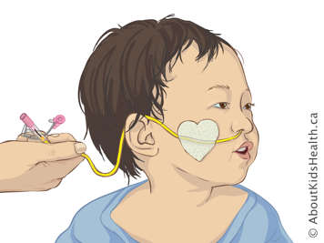 Child with a nasogastric tube