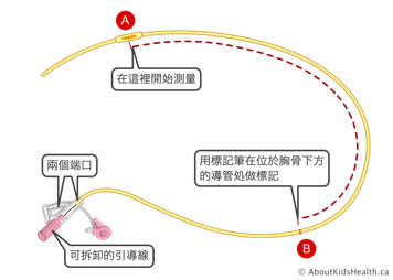 在帶有兩個端口和可拆卸導線的鼻胃管上做標記