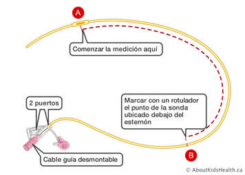 Marcas en una sonda nasogástrica con dos puertos y cable guía desmontable