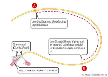 இரு முனைகள் மற்றும் அகற்றக்கூடிய காப்பிடப்பட்ட வயர் கொண்ட NG குழாயில் அடையாளங்கள்