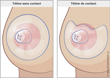 Des seins avec tétine sans contact et avec tétine de contact