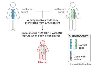 Baby inherits one copy of gene from each unaffected parent with spontaneous new gene variant causing baby to be affected with Noonan syndrome.