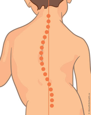 Orange dotted line showing the curve in a child's spine