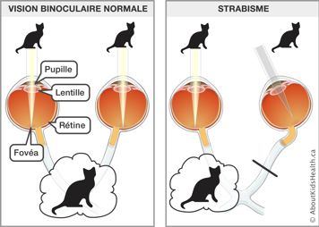 La vision binoculaire normale avec les deux yeux regardant une image et le strabisme montré avec seulement un œil sur l’image