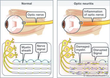 Inflamed optic nerve with damaged myelin sheaths, causing nerve signal to be disrupted