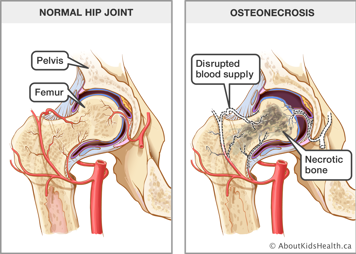 Normal hip joint and hip joint affected by osteonecrosis