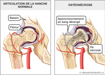 Illustration d’un articulation de la hanche normale et d’un articulation de la hanche atteint d’ostéonécrose